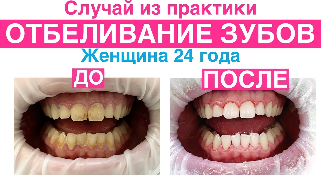 Zoom 3 метод для отбеливания зубов: преимущества, недостатки и отзывы
