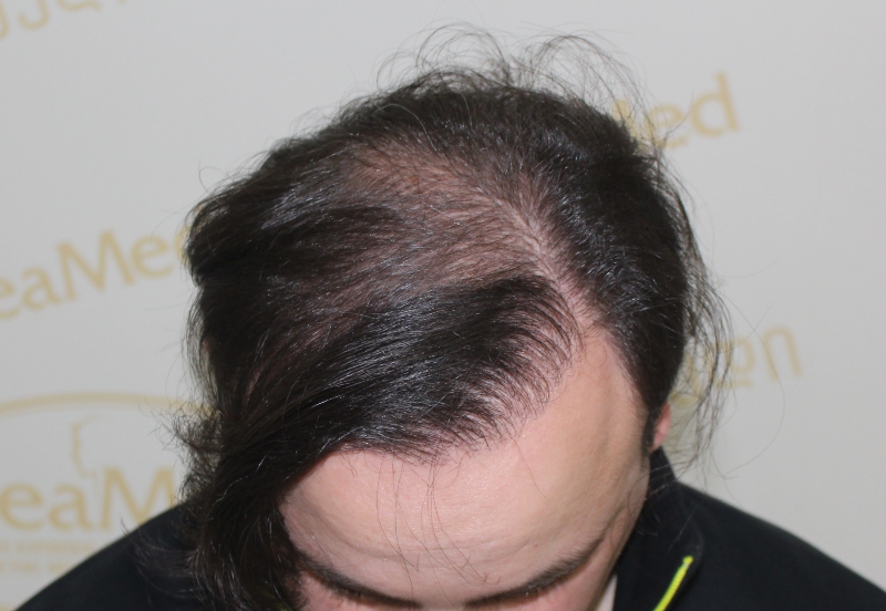 Алопеция, или выпадение волос. причины выпадения волос и типы облысения