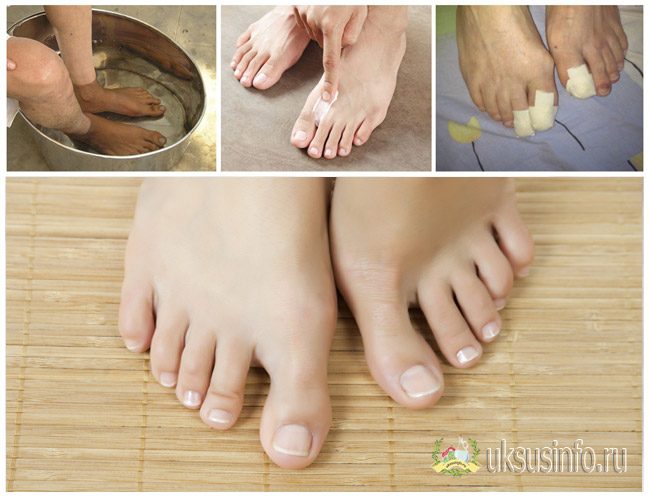 Ванночки от грибка ногтей на ногах — эффективные рецепты