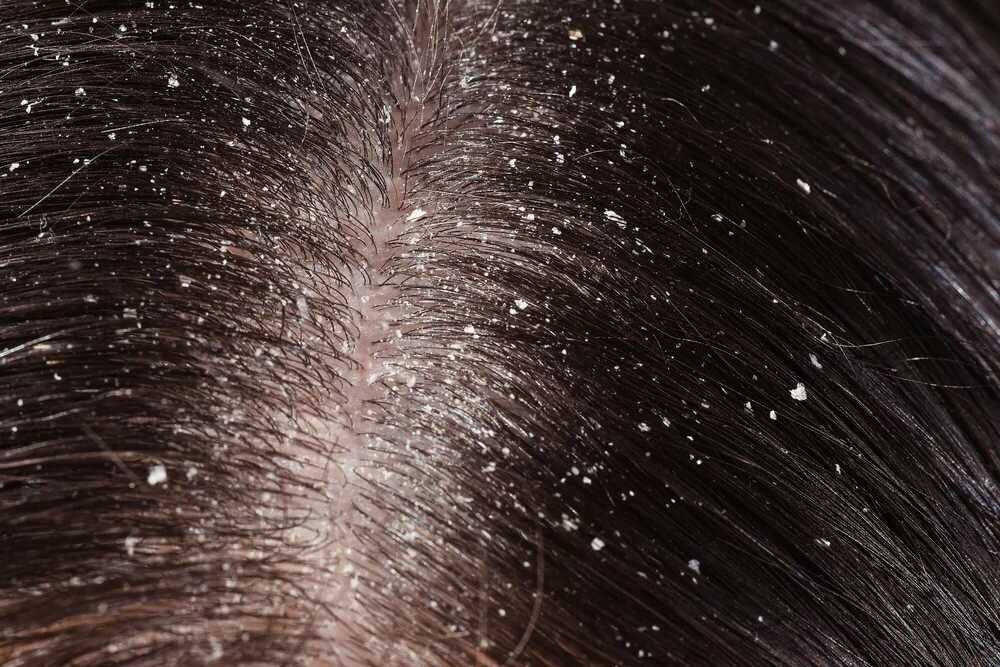 Лечение сухой себореи кожи головы – публикации – лаборатория ан-тек