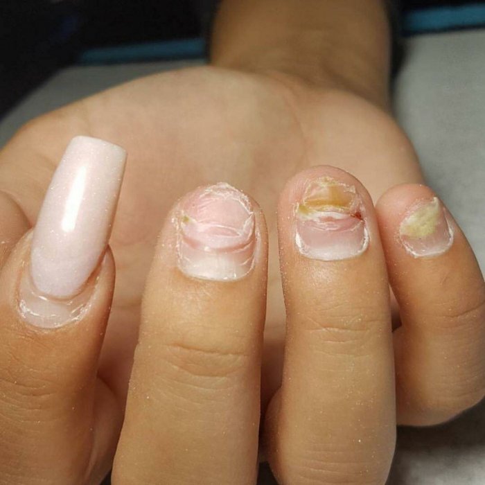 Возможные последствия при наращивании ногтей