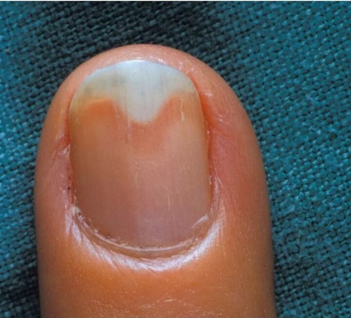Что делать, если отошли ногти после снятия гель-лака