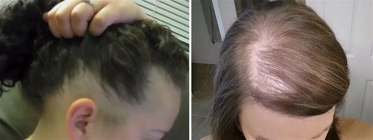Как восстановить волосы после родов | а клиника