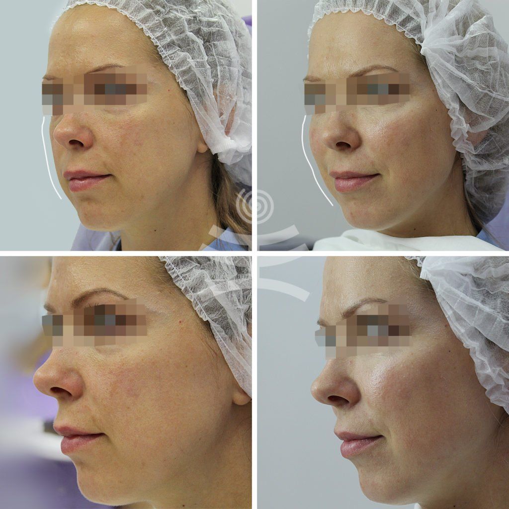 Контурная пластика лица филлерами фото до и после