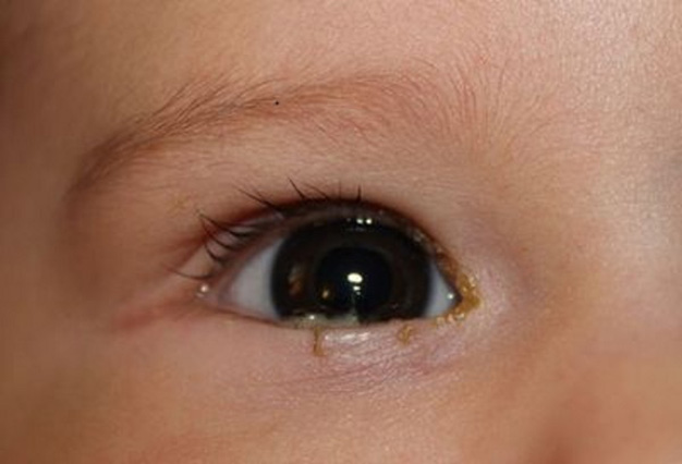 Почему у ребенка гноятся глаза?