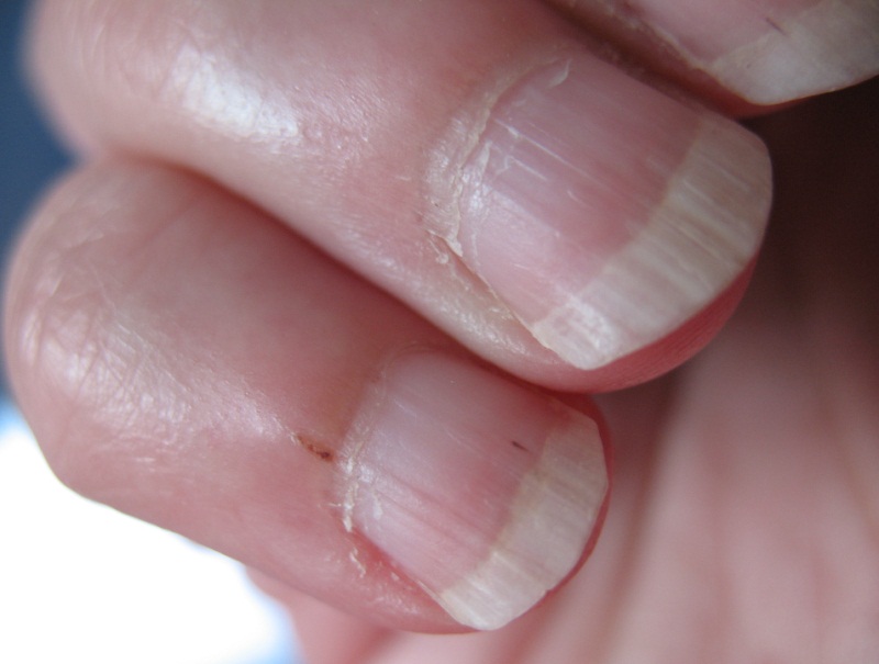 Заусенцы на пальцах рук: причины, как избавиться и чем лечить