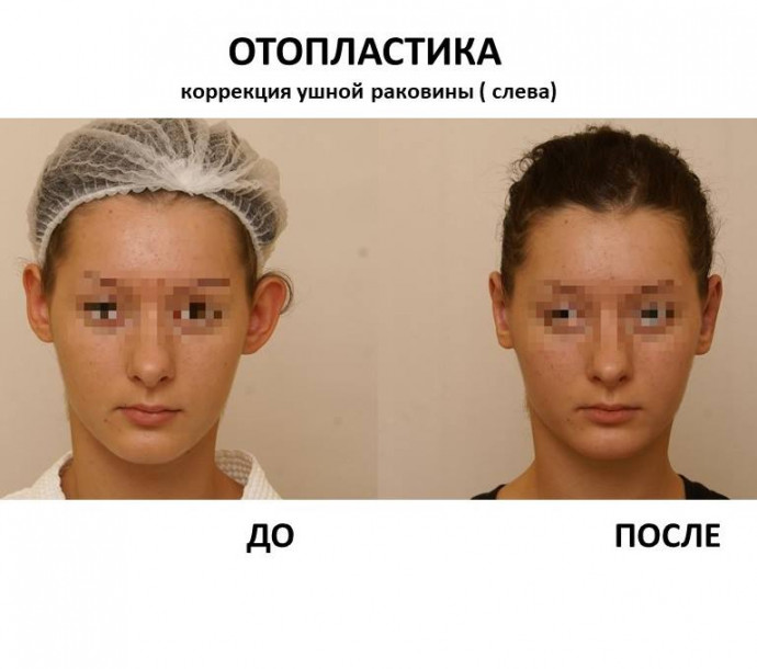 Отопластика