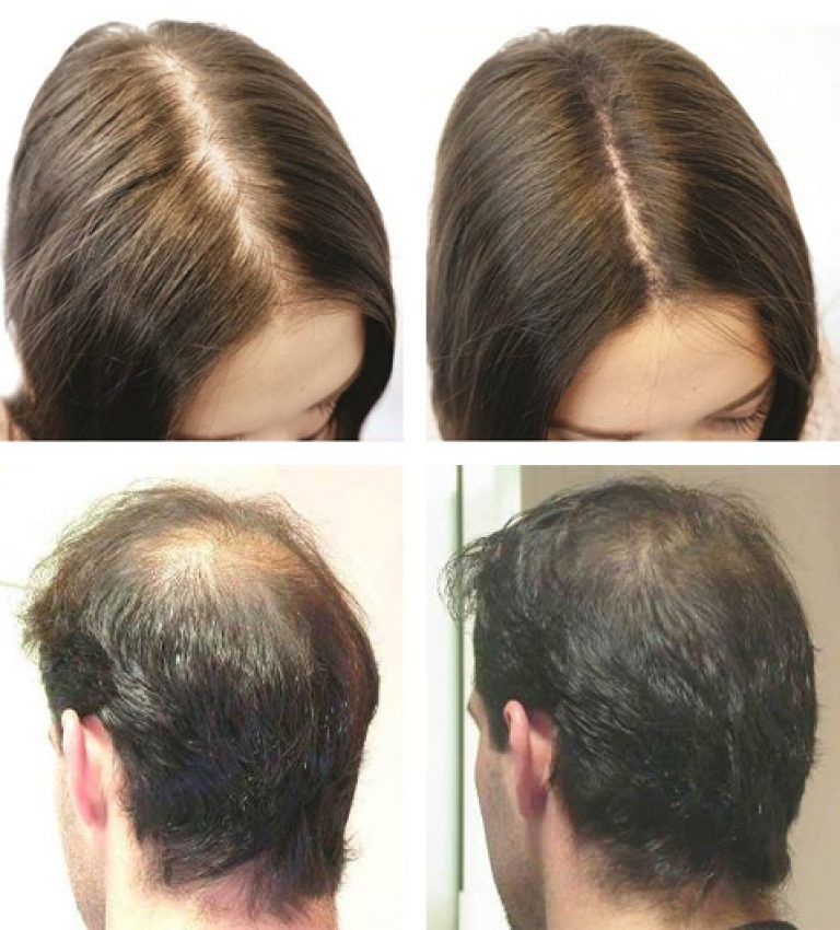 Алопеция через сколько придут волосы в норму
