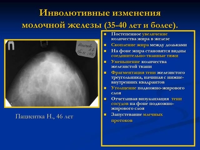 Рак педжета: фото, признаки и лечение при раке соска молочной железы и ореол