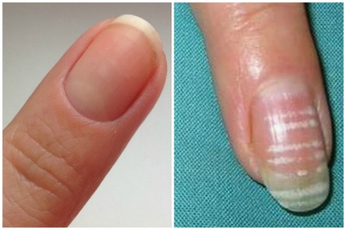 Причины появления белых полосок на ногтях