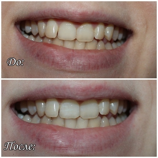 Отбеливание зубов при кариесе — возможно ли это? - энциклопедия ochkov.net