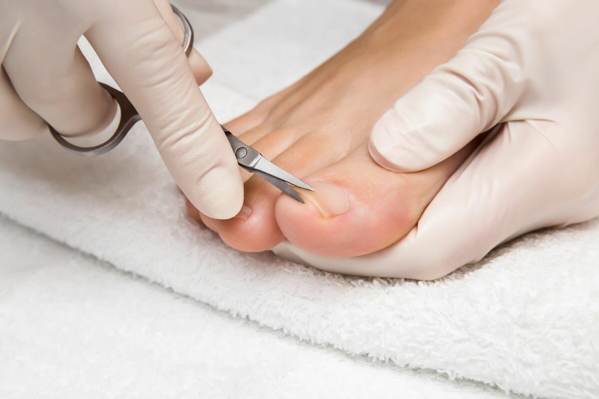 Грибок ногтей на ногах — средства для лечения