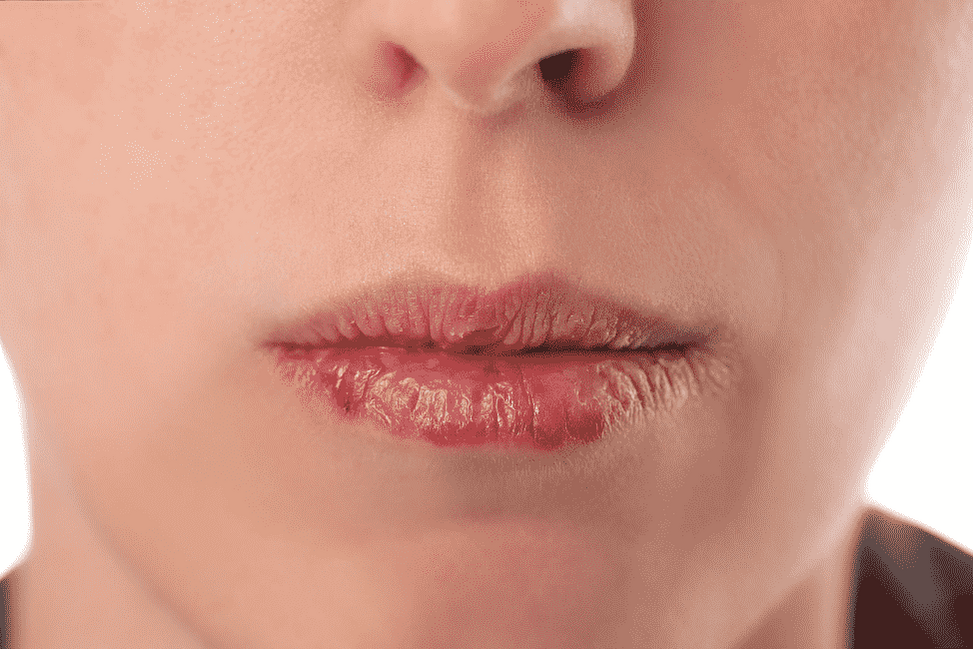 Раздражение в уголках губ – что делать с «заедами»?