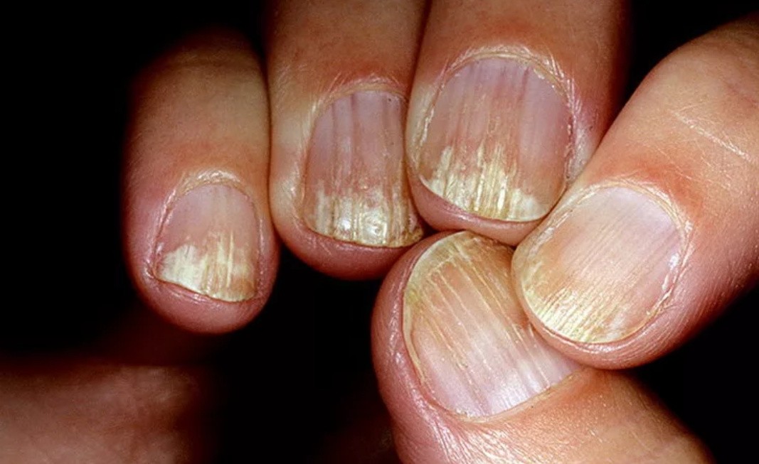 Ребристые полосы на ногтях. Ониходистрофия - онихолизис.. Онихорексис трахионихия. Подногтевой гиперкератоз. Гиперкератоз и онихолизис..