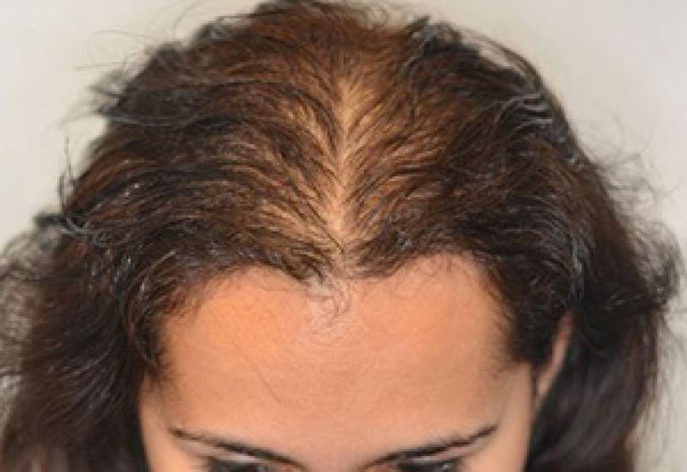 Основные причины выпадения волос