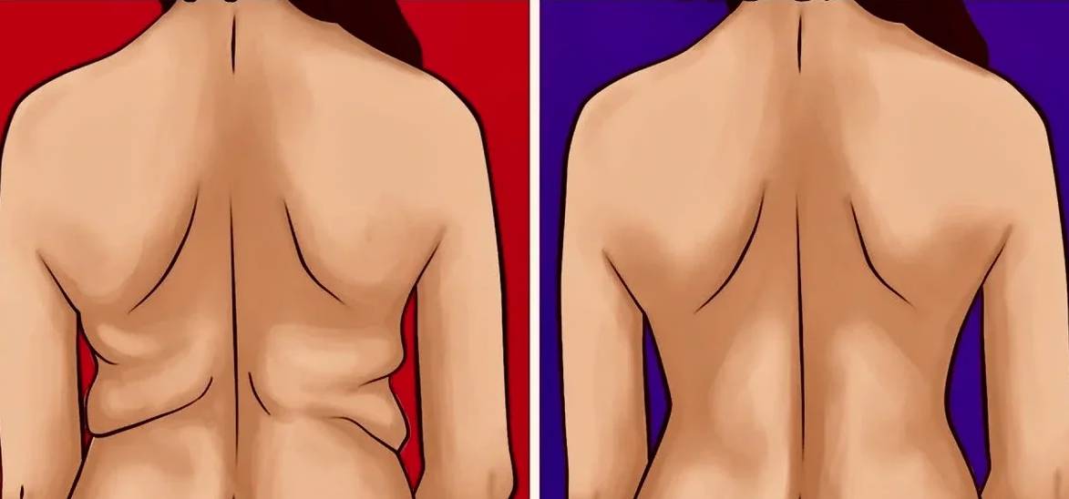 Как убрать жировые складки на спине: питание, упражнения и массаж