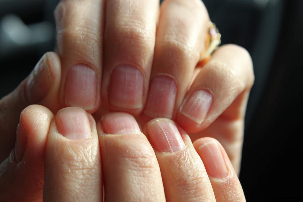 Что означают продольные и поперечные полосы на ногтях рук? Причины и лечение