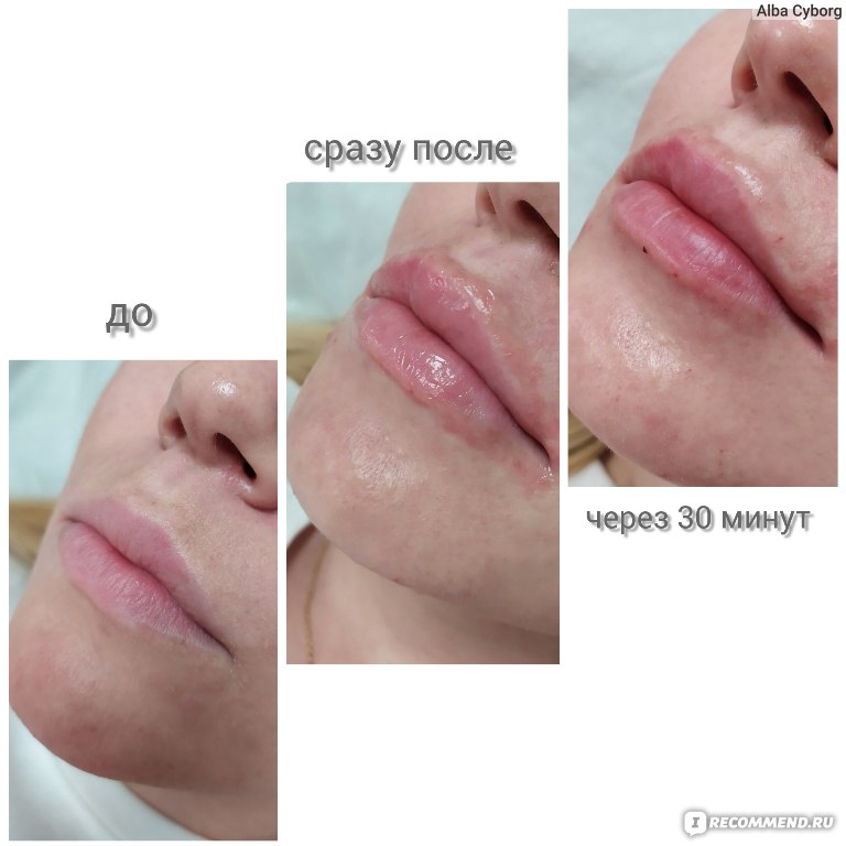 Увеличение губ: популярные техники и виды, как ухаживать за губами. противопоказания, что нельзя после процедуры, сколько держится результат