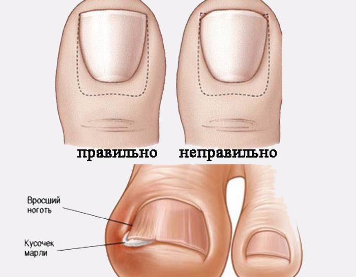 Онихогрифоз или когтеобразные ногти: что вызывает и как бороться?