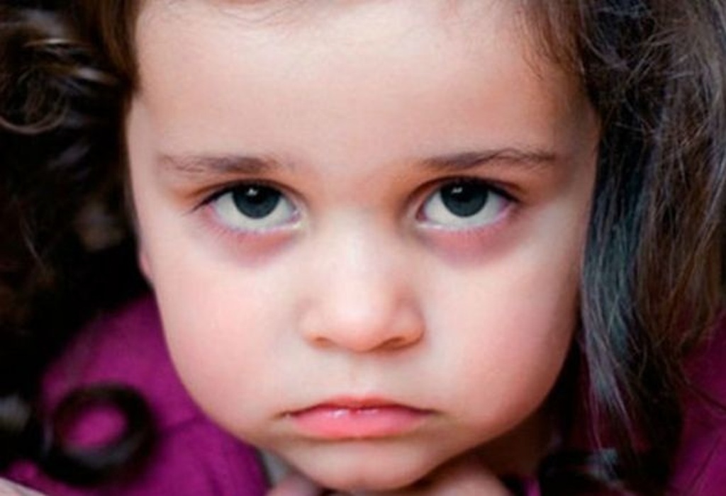 У ребенка темные круги под глазами почему. Синякитподтшлазами у ребенка. Круги под глазами у ребенка. Детские глаза. Тёмные круги под глазами у ребёнка.