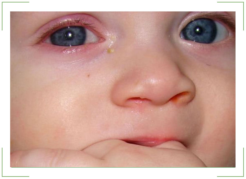 Можно ли протирать глаза фурацилином грудничкам - детская городская поликлиника №1 г. магнитогорска