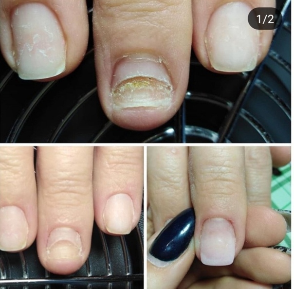 Как восстановить ногти после наращивания. основные способы