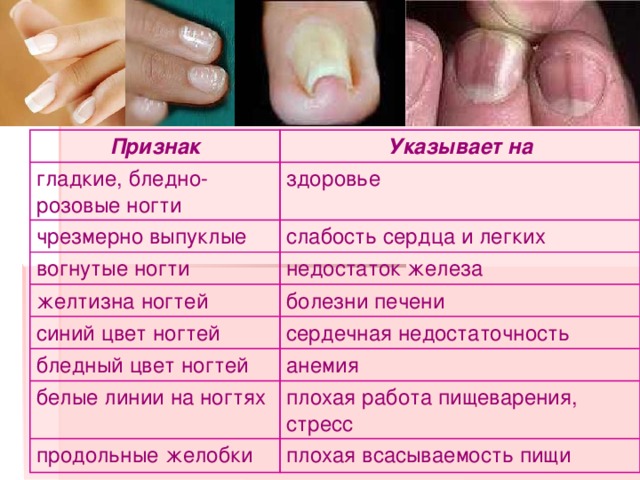 Болезни ногтей - для пациентов - внутренняя mедицина