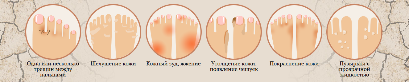 Облазит кожа на ногах и пальцах ног: в чем причина