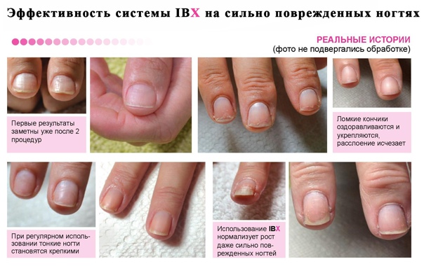 Лучшие способы восстановления ногтей после наращивания