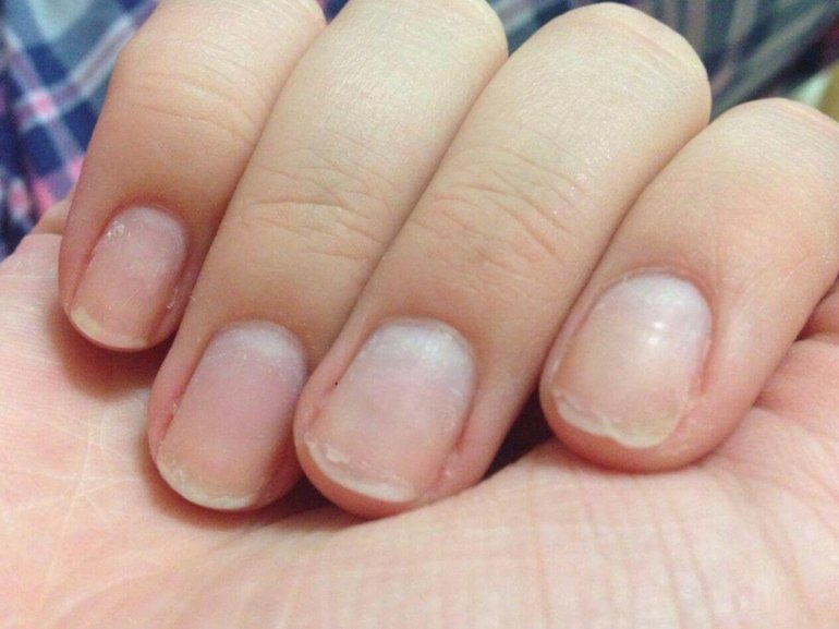 Почему врастает ноготь и как эффективно лечить вросший ноготь?