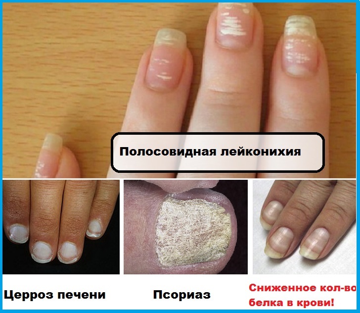 Грибок ногтей на руках после гель лака как выглядит чем лечить в домашних условиях фото