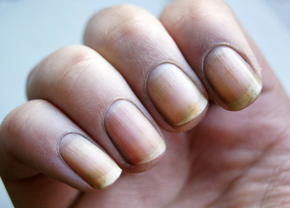 Почему желтеют ногти на руках у женщины