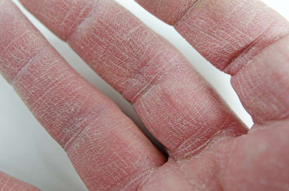 Трещины между пальцами на ногах: почему лопается кожа, причины и лечение народными средствами в домашних условиях, что делать, если трескается, чешется и болит