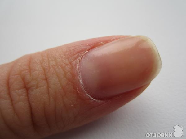 Сухая кутикула и кожа вокруг ногтей – устранить в домашних условиях