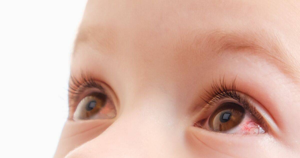 Покраснели глаза у ребенка — что это может быть?
