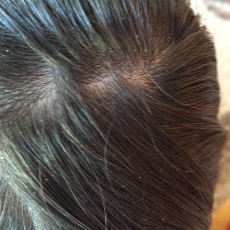 Как отличить гнид от перхоти — советы, которые не дадут вам ошибиться | bellehair.info