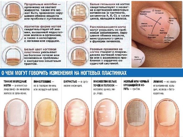 Как быстро вылечить желтые ногти на руках: причины, профилактические меры, способы лечения