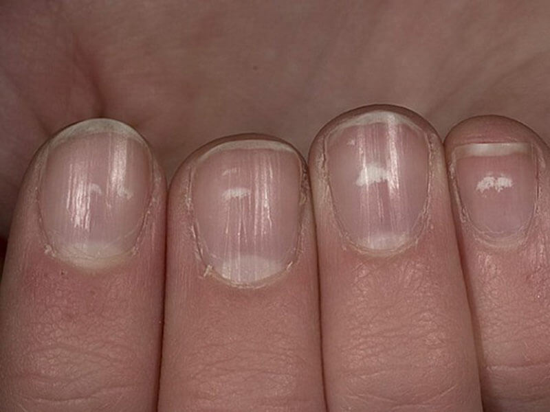 Причины, почему бывает деформация ногтей на руках с фото дефектов