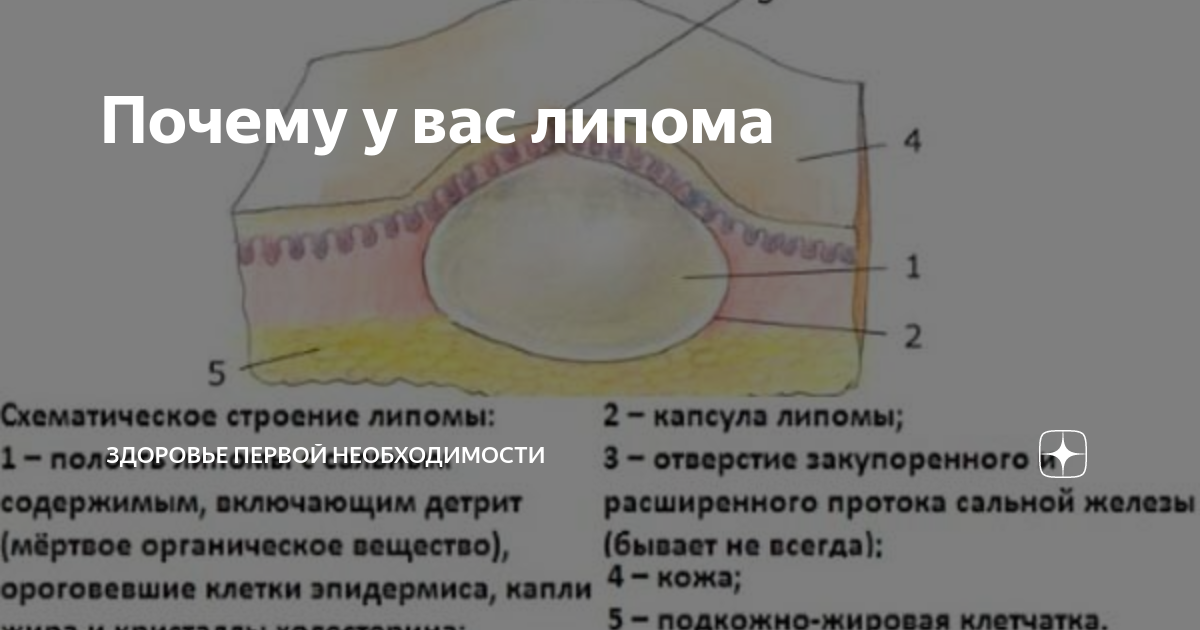 Липома (жировик, липобластома, жировая опухоль)
