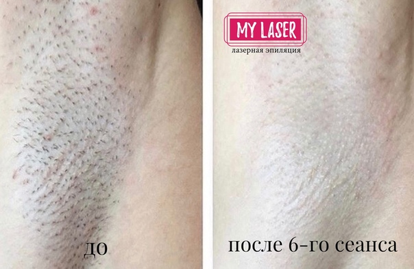 Лазерная эпиляция помогает в некоторой степени омолодить кожу - косметология доктора корчагиной