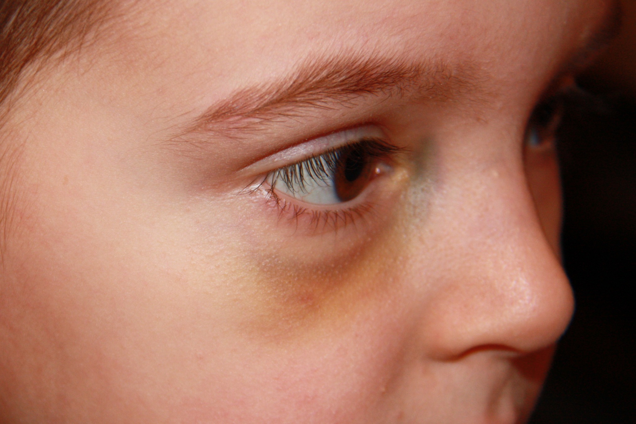Какие признаки указывают на наличие конъюнктивита у ребенка?