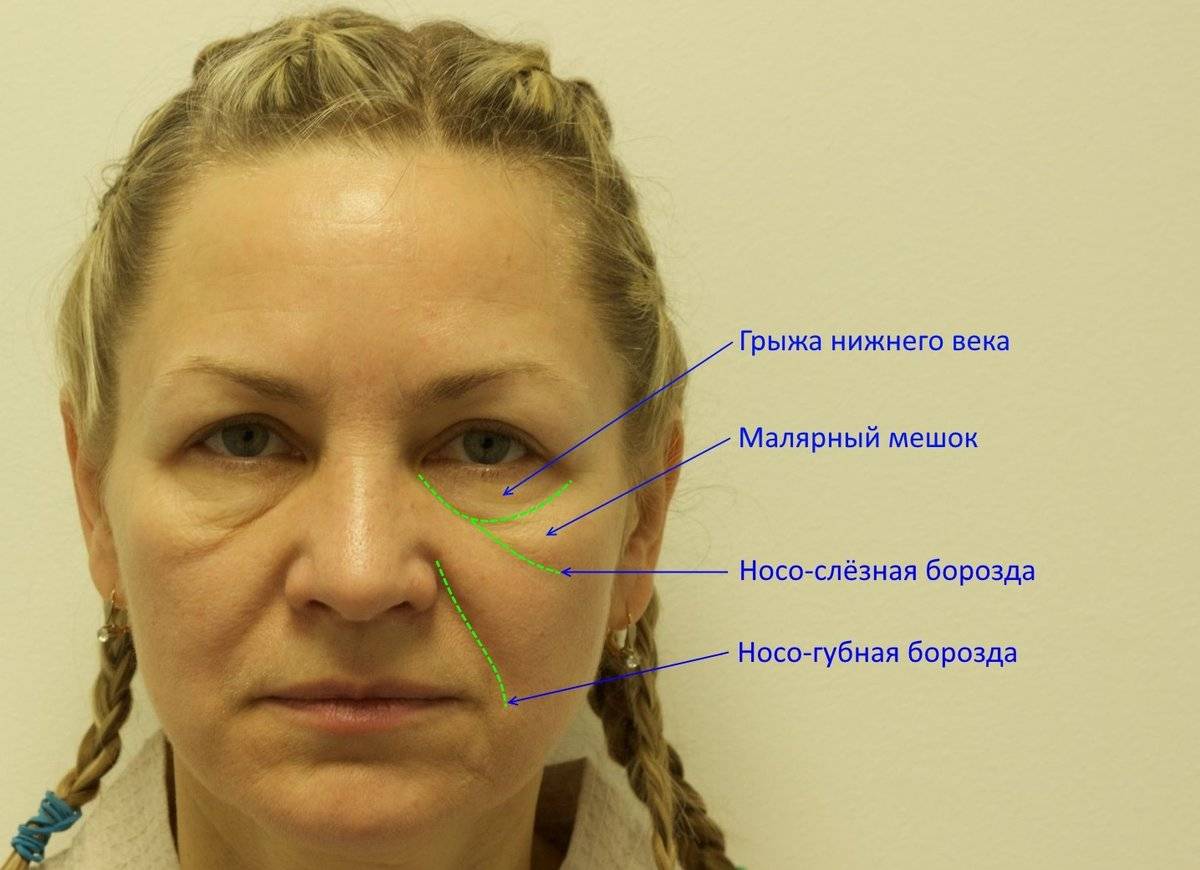 Отеки под глазами