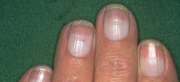 Почему появляются белые пятна на ногтях?