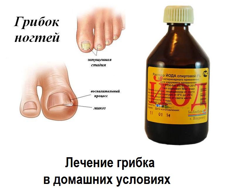 Дешевое и эффективное средство от грибка ногтей на ногах и руках