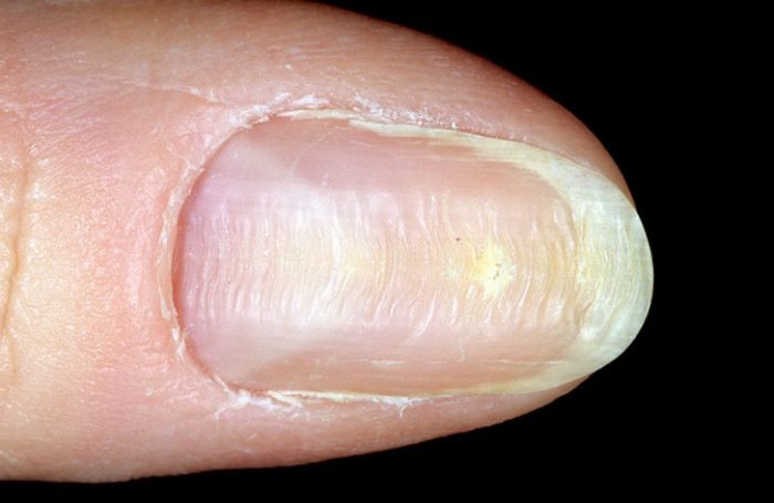 Почему ногти на руках волнистые, причины, лечение, фото
