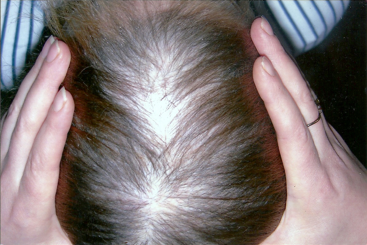Избыточный рост волос на теле