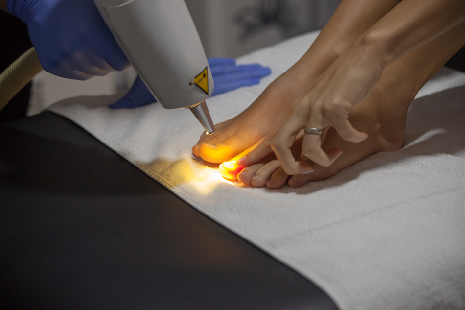 Лазерное лечение ногтевого грибка