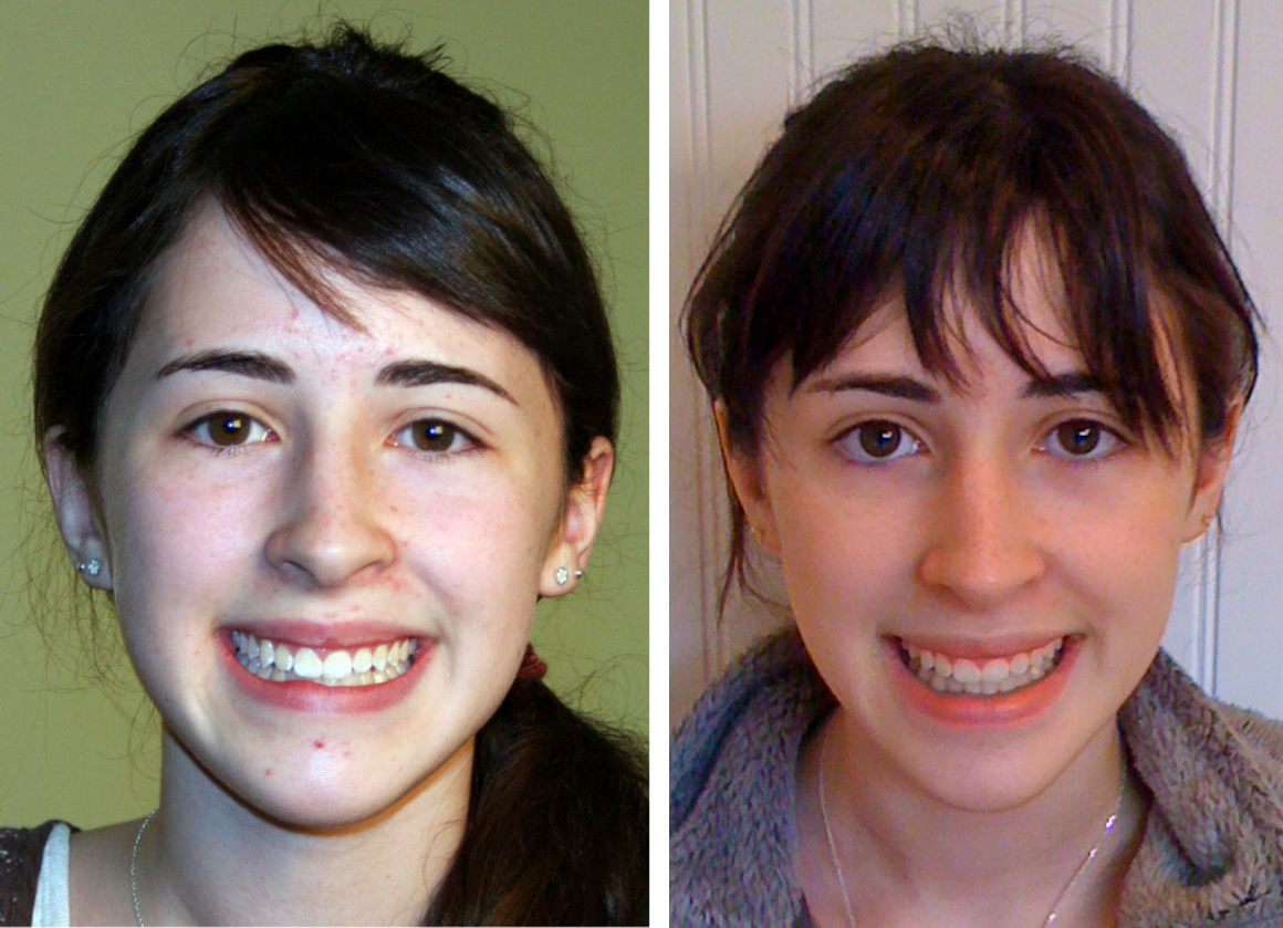 Как изменяется лицо после брекетов фото до и после