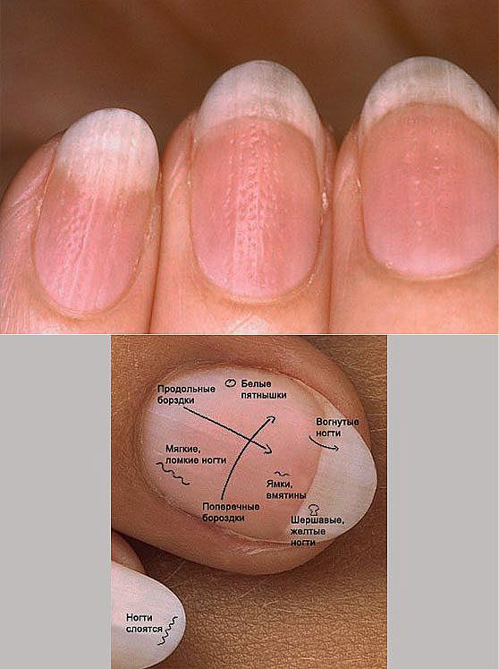 Почему ногти на руках ребристые вертикально у женщин фото причины симптомы и лечение
