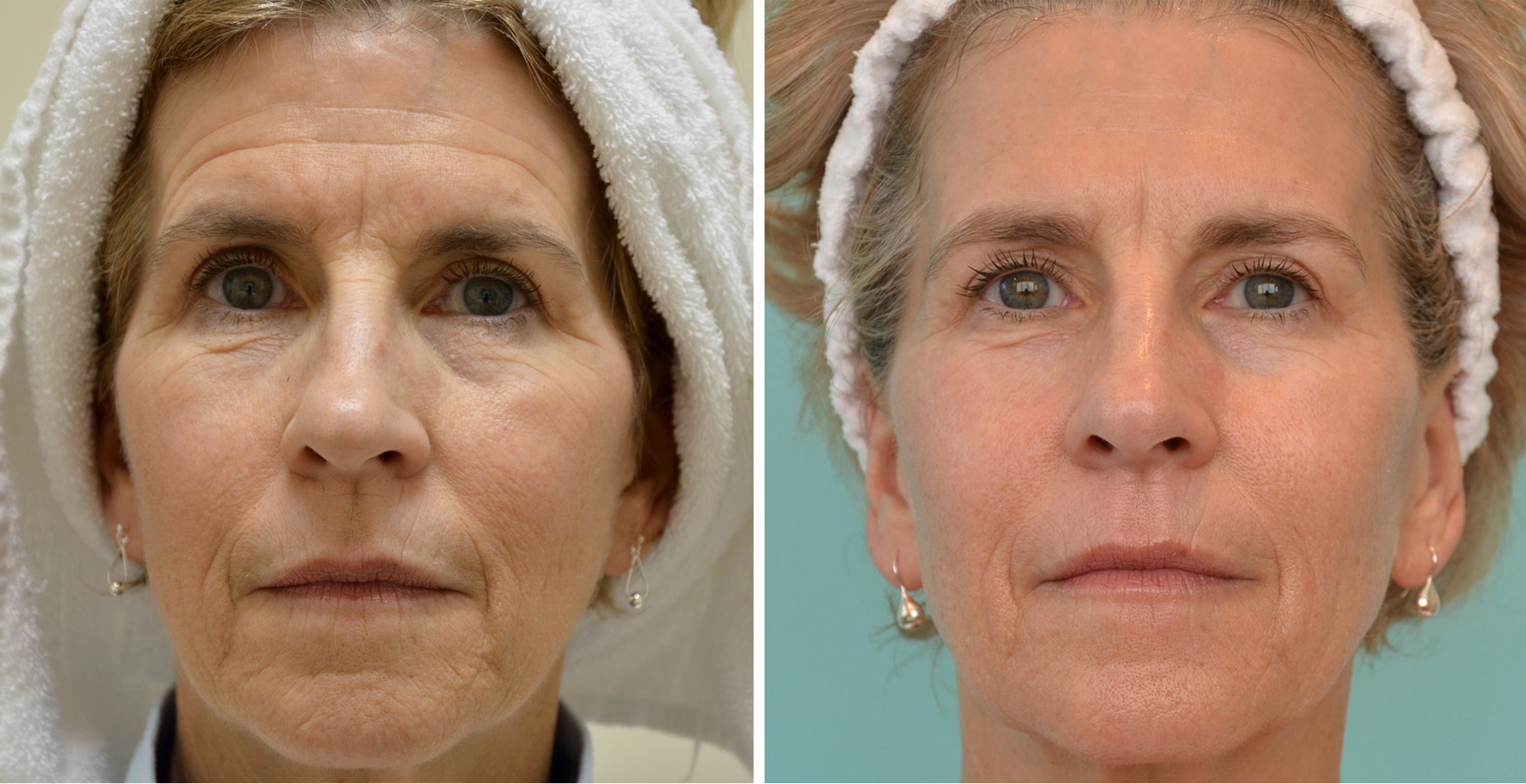 Процедура для лица после 60. Омоложение лица до и после. Морщины на лице. Микротоки для лица результат. Омоложение морщины.